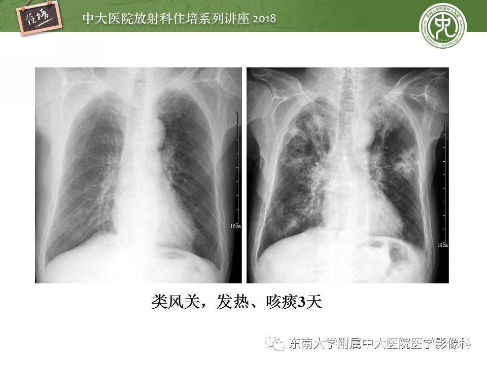 【PPT】肺部感染性疾病影像诊断及鉴别（一）