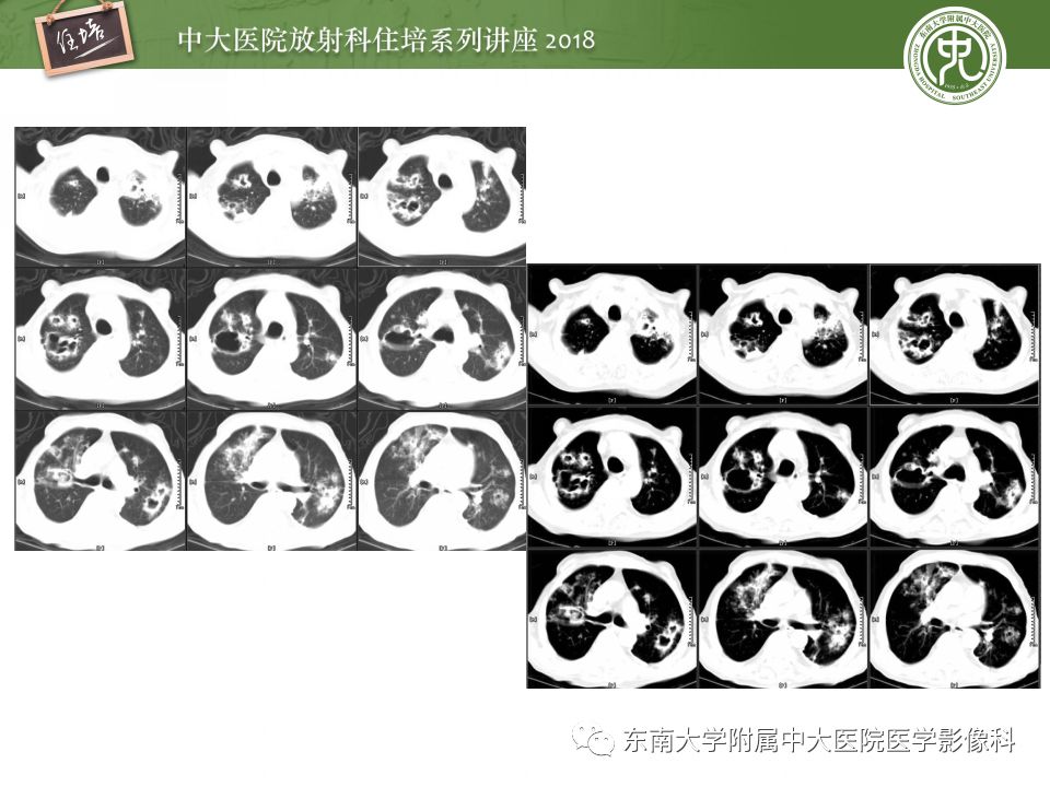 【PPT】肺部感染性疾病影像诊断及鉴别（一）