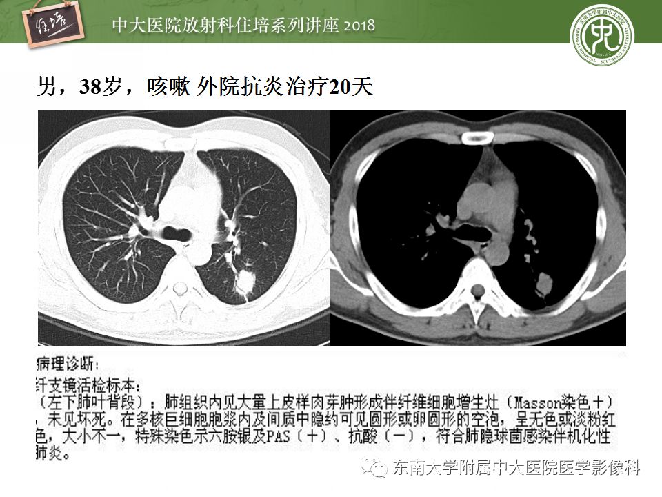 【PPT】肺部感染性疾病影像诊断及鉴别（一）