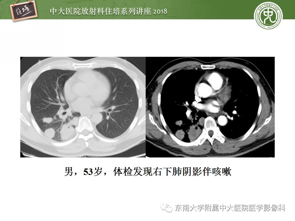 【PPT】肺部感染性疾病影像诊断及鉴别（一）
