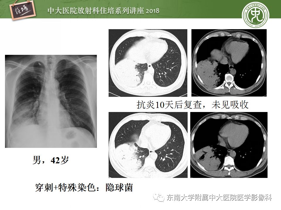 【PPT】肺部感染性疾病影像诊断及鉴别（一）