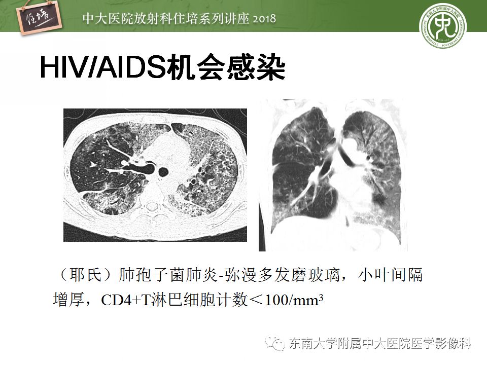 【PPT】肺部感染性疾病影像诊断及鉴别（一）