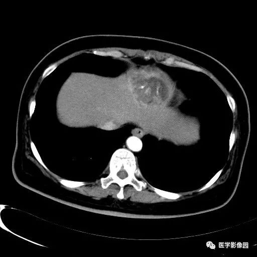 【病例】肝癌伴脂肪变性1例CT影像表现 【病例】肝癌伴脂肪变性1例CT影像表现