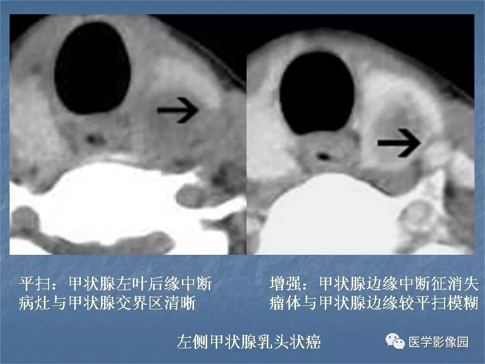 【PPT】甲状腺结节的CT鉴别诊断