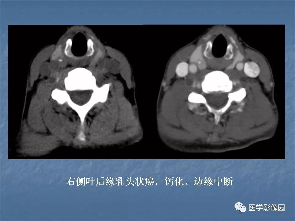 【PPT】甲状腺结节的CT鉴别诊断