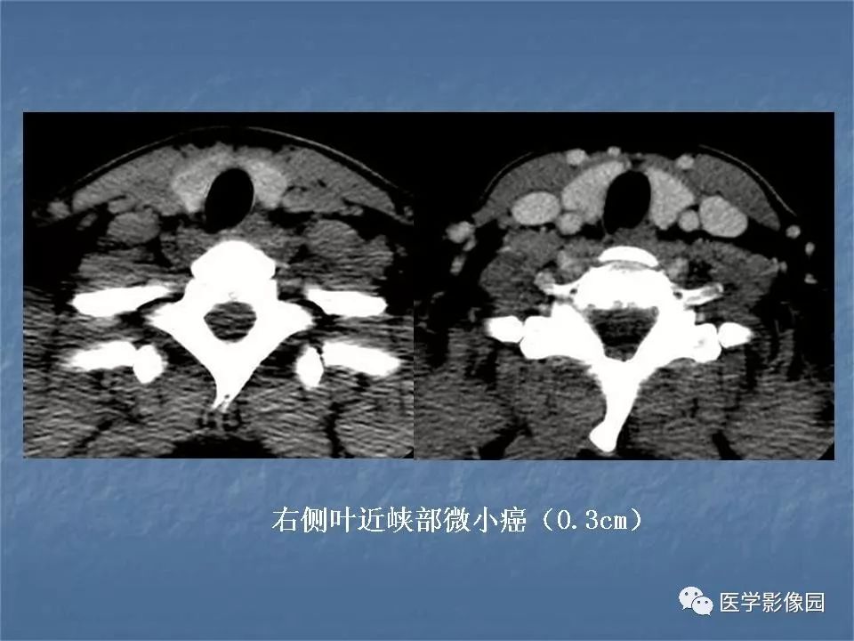【PPT】甲状腺结节的CT鉴别诊断