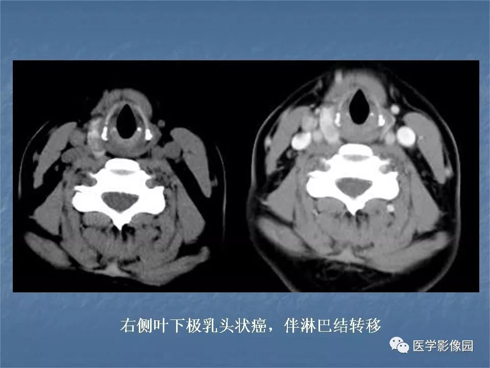 【PPT】甲状腺结节的CT鉴别诊断
