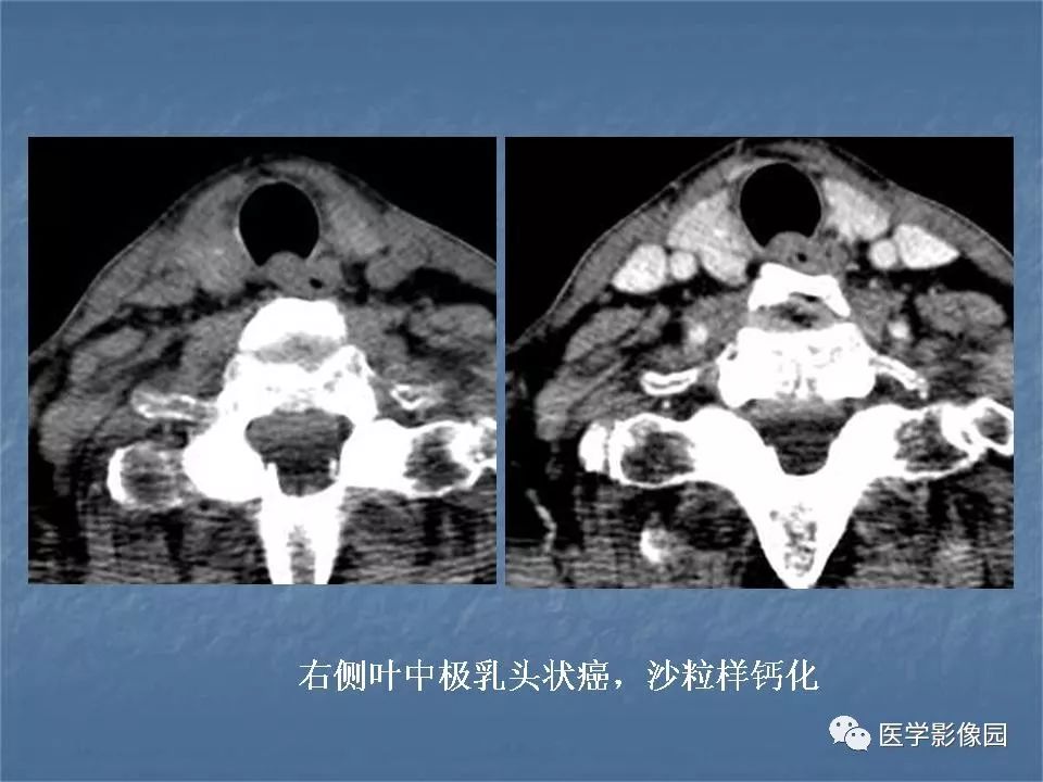 【PPT】甲状腺结节的CT鉴别诊断