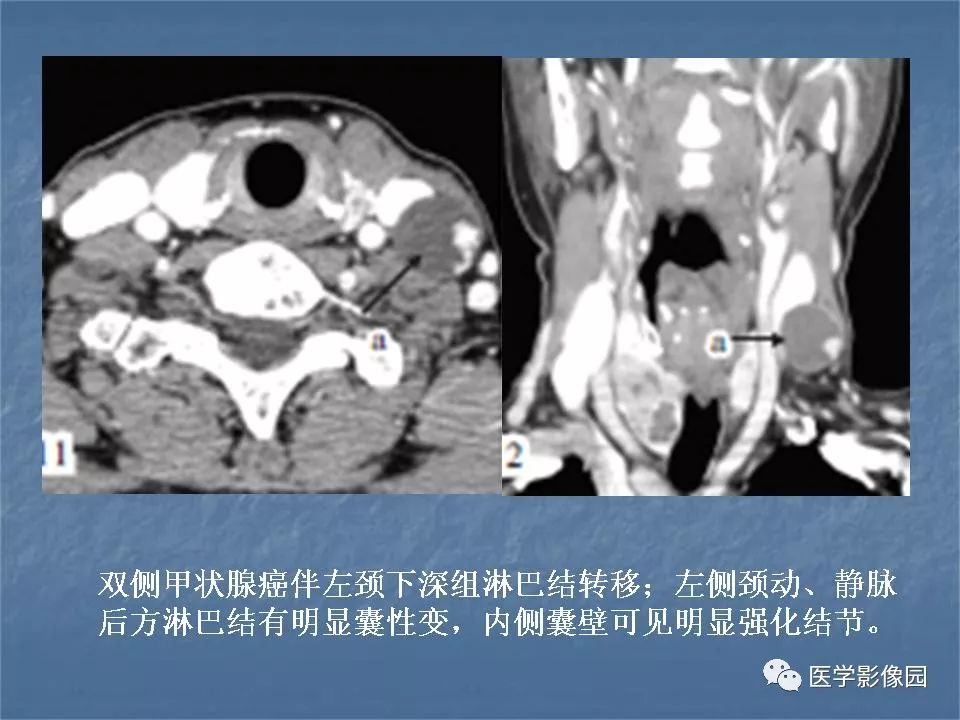 【PPT】甲状腺结节的CT鉴别诊断