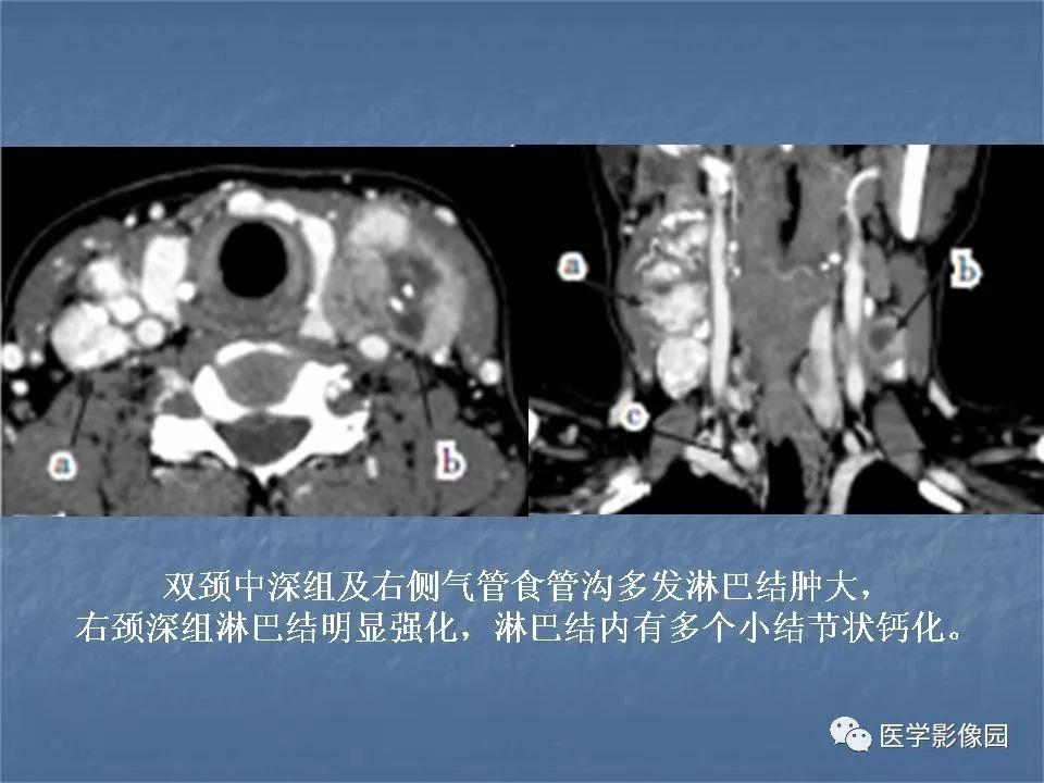 【PPT】甲状腺结节的CT鉴别诊断