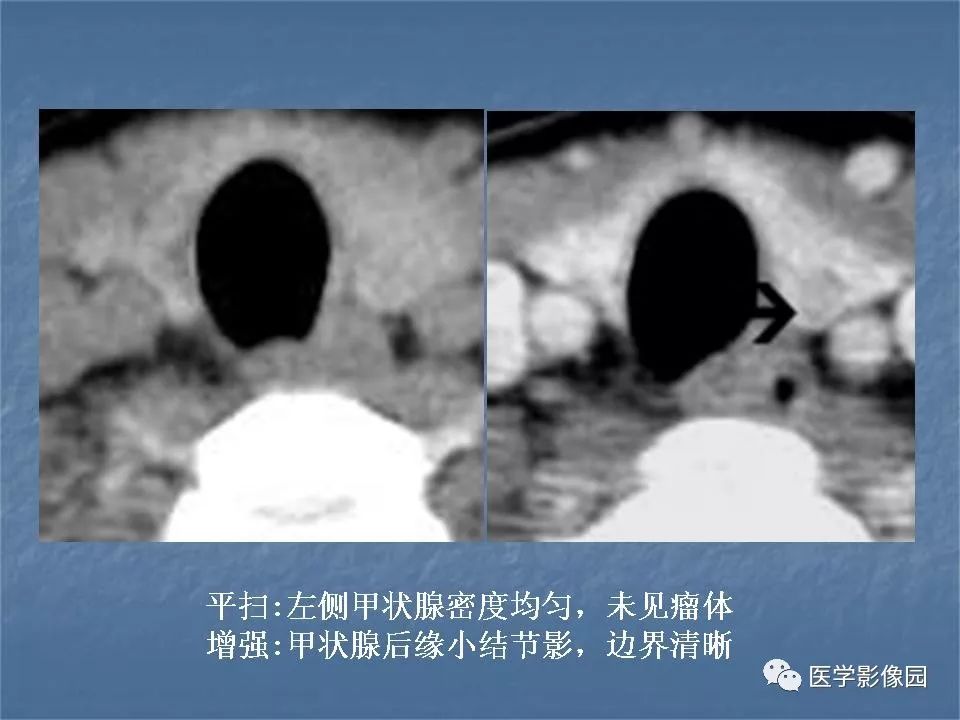 【PPT】甲状腺结节的CT鉴别诊断