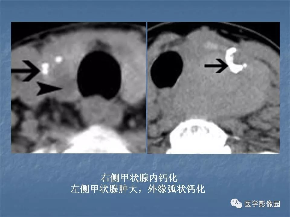 【PPT】甲状腺结节的CT鉴别诊断