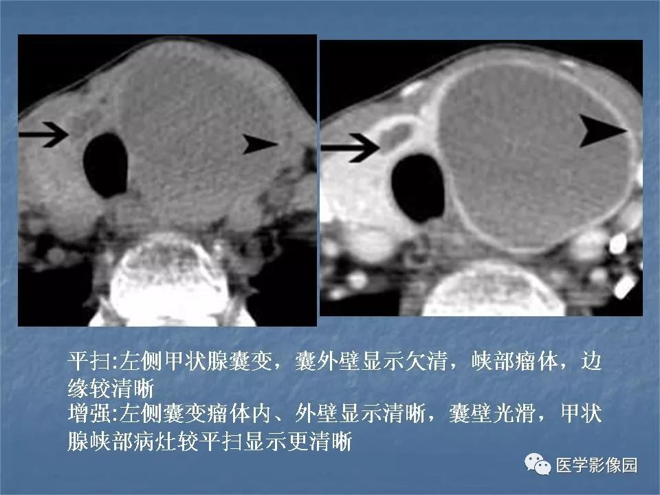 【PPT】甲状腺结节的CT鉴别诊断