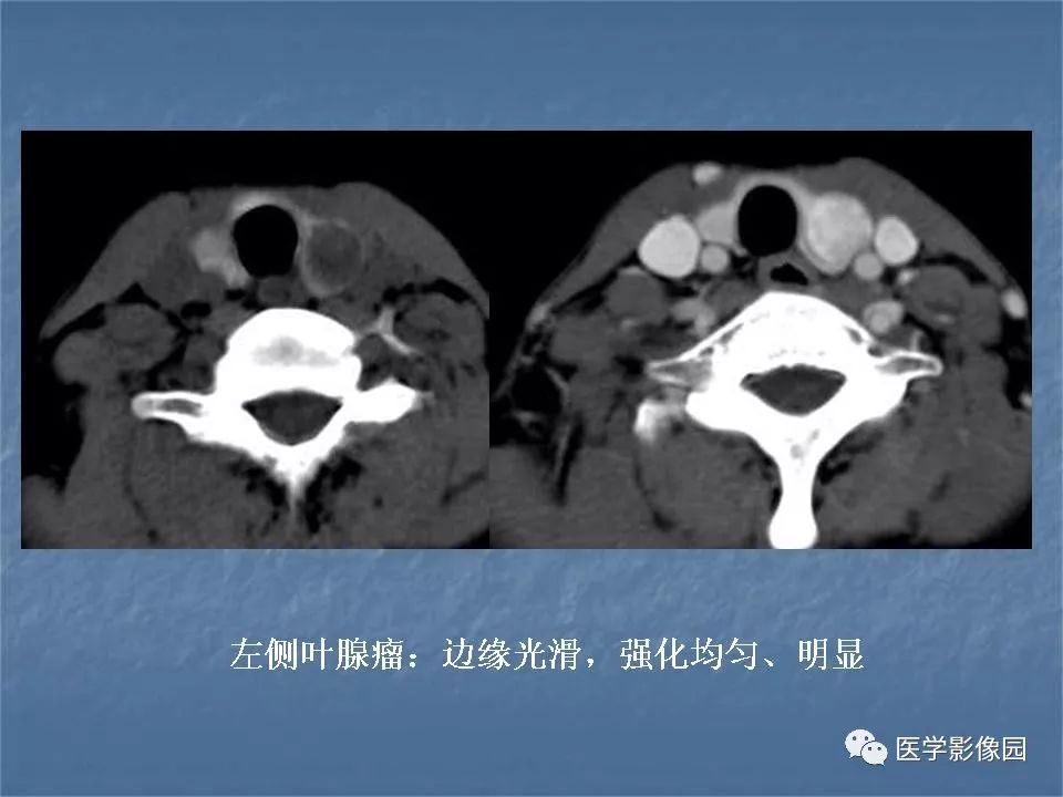 【PPT】甲状腺结节的CT鉴别诊断