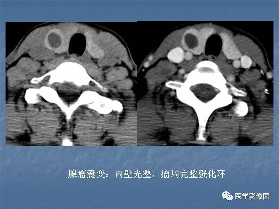 【PPT】甲状腺结节的CT鉴别诊断