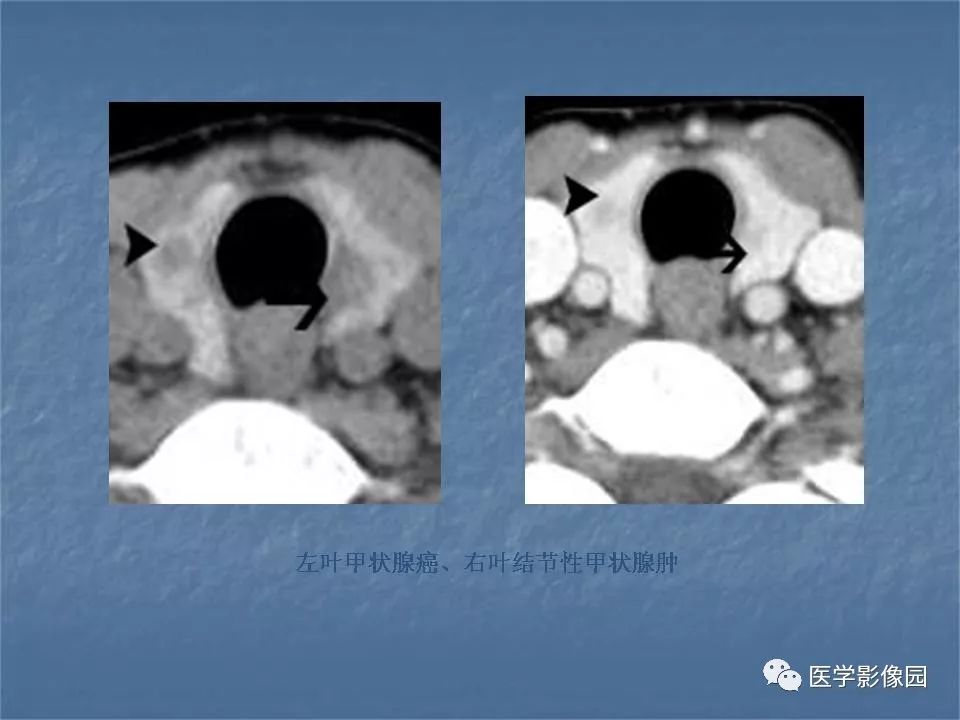 【PPT】甲状腺结节的CT鉴别诊断