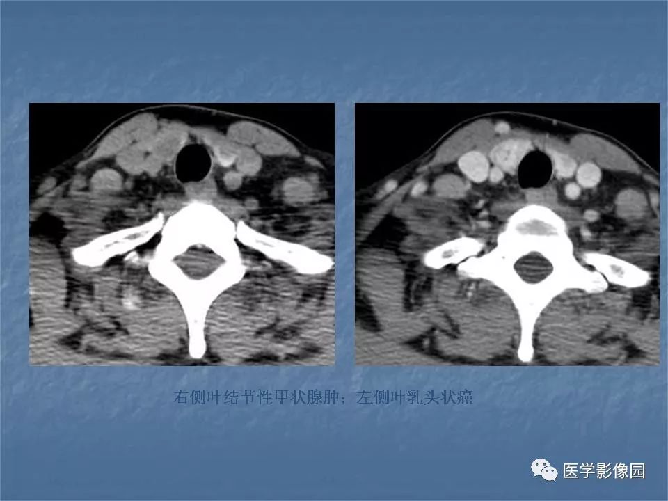 【PPT】甲状腺结节的CT鉴别诊断