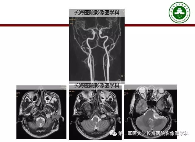 【PPT】颈静脉孔区常见病变的诊断与鉴别诊断