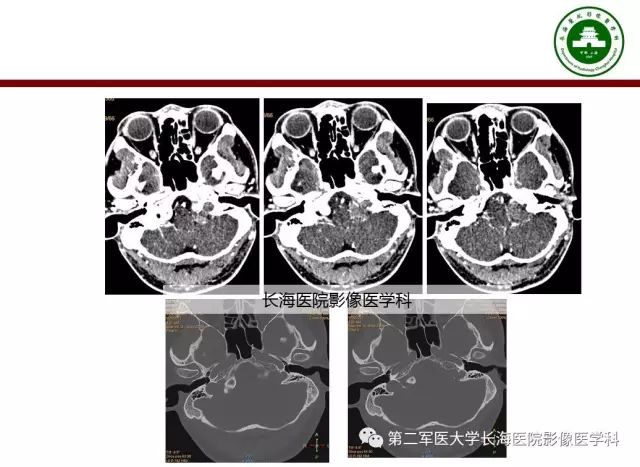 【PPT】颈静脉孔区常见病变的诊断与鉴别诊断