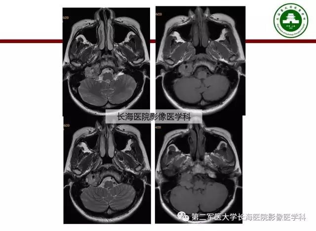 【PPT】颈静脉孔区常见病变的诊断与鉴别诊断