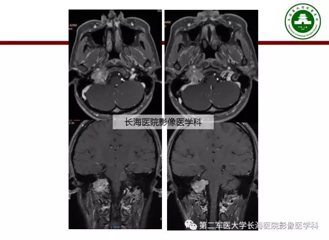 【PPT】颈静脉孔区常见病变的诊断与鉴别诊断