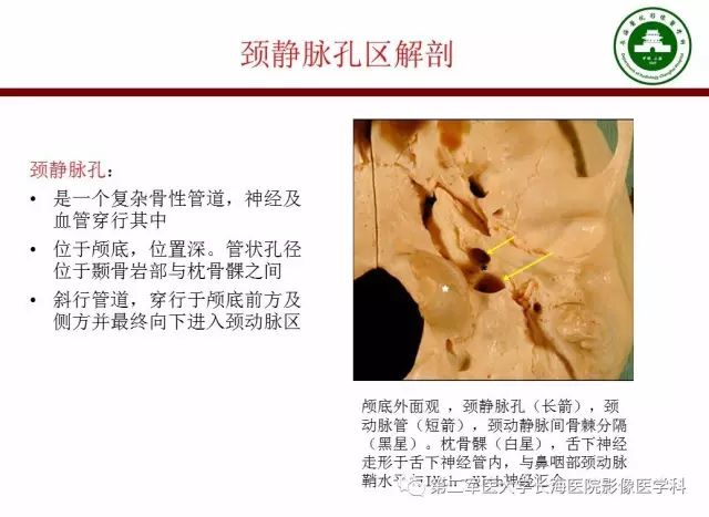 【PPT】颈静脉孔区常见病变的诊断与鉴别诊断