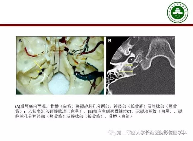 【PPT】颈静脉孔区常见病变的诊断与鉴别诊断