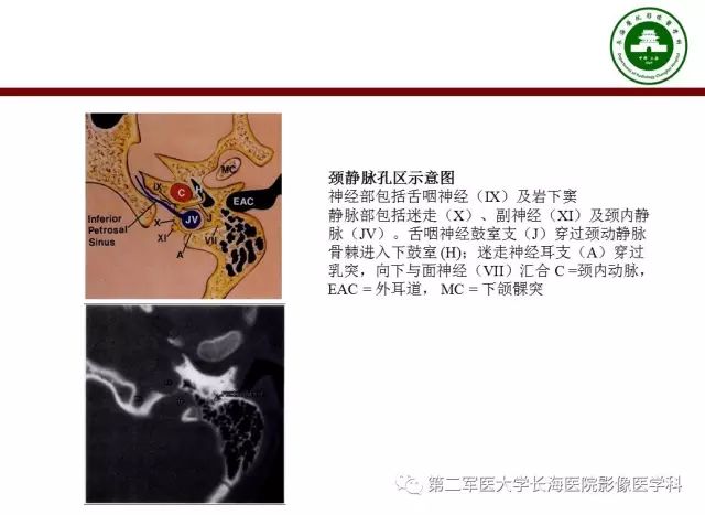【PPT】颈静脉孔区常见病变的诊断与鉴别诊断