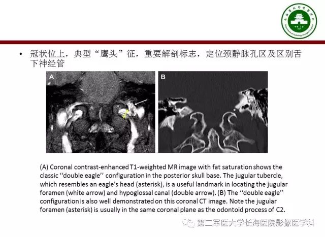 【PPT】颈静脉孔区常见病变的诊断与鉴别诊断