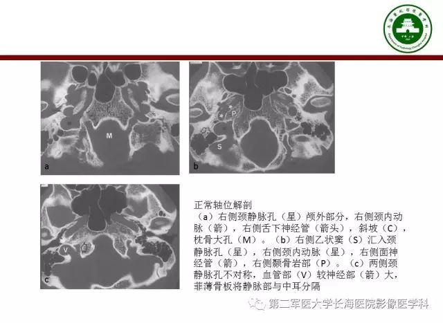 【PPT】颈静脉孔区常见病变的诊断与鉴别诊断