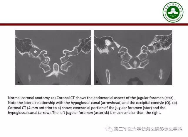 【PPT】颈静脉孔区常见病变的诊断与鉴别诊断