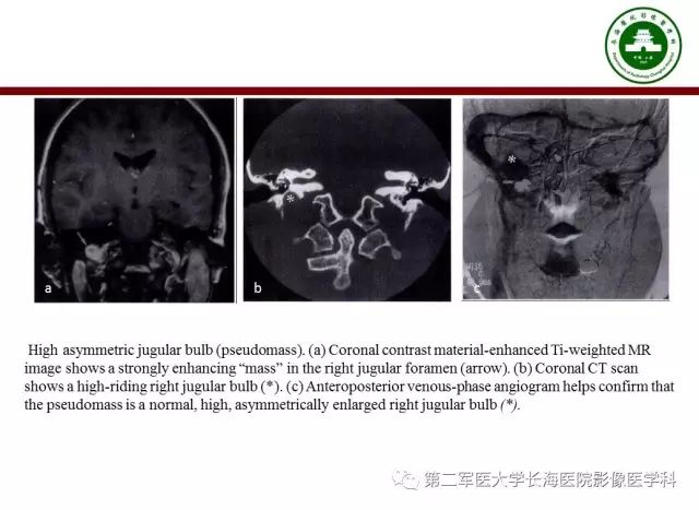 【PPT】颈静脉孔区常见病变的诊断与鉴别诊断