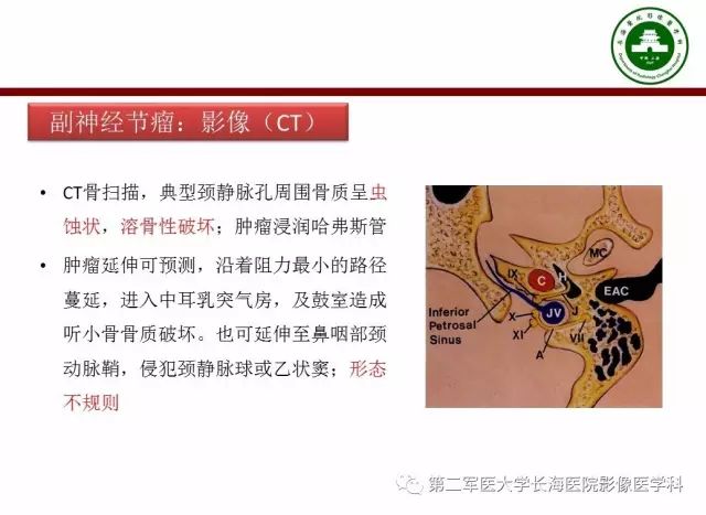 【PPT】颈静脉孔区常见病变的诊断与鉴别诊断