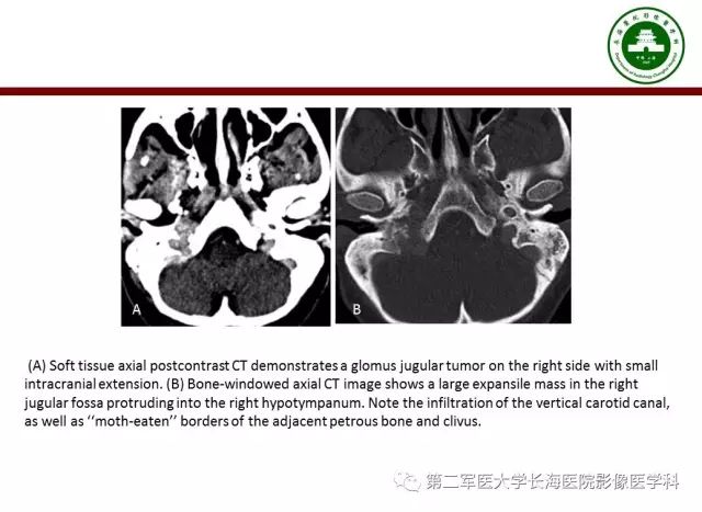 【PPT】颈静脉孔区常见病变的诊断与鉴别诊断