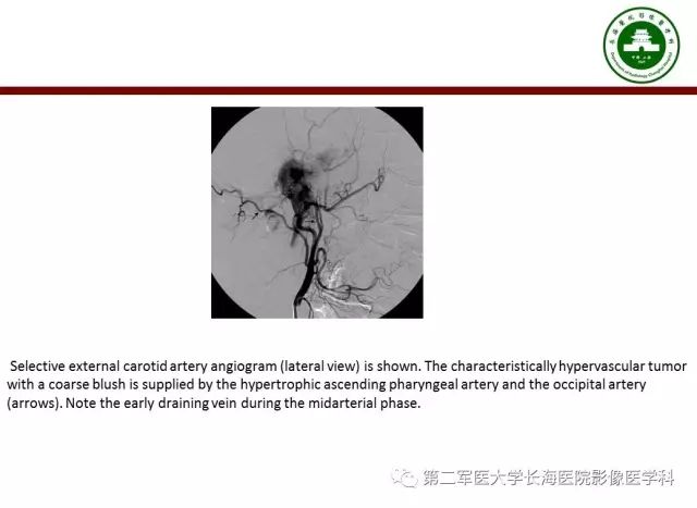 【PPT】颈静脉孔区常见病变的诊断与鉴别诊断
