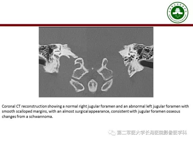 【PPT】颈静脉孔区常见病变的诊断与鉴别诊断