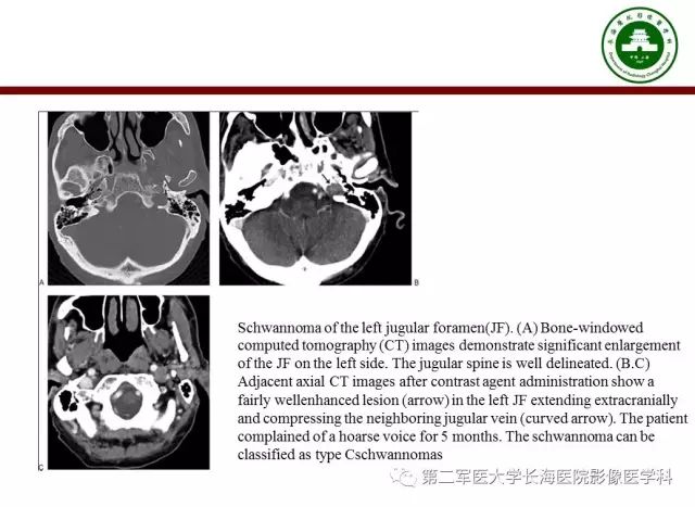 【PPT】颈静脉孔区常见病变的诊断与鉴别诊断