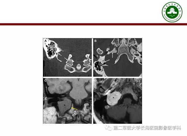 【PPT】颈静脉孔区常见病变的诊断与鉴别诊断
