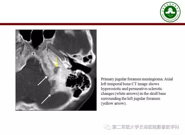 【PPT】颈静脉孔区常见病变的诊断与鉴别诊断