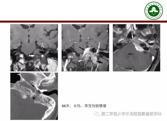 【PPT】颈静脉孔区常见病变的诊断与鉴别诊断