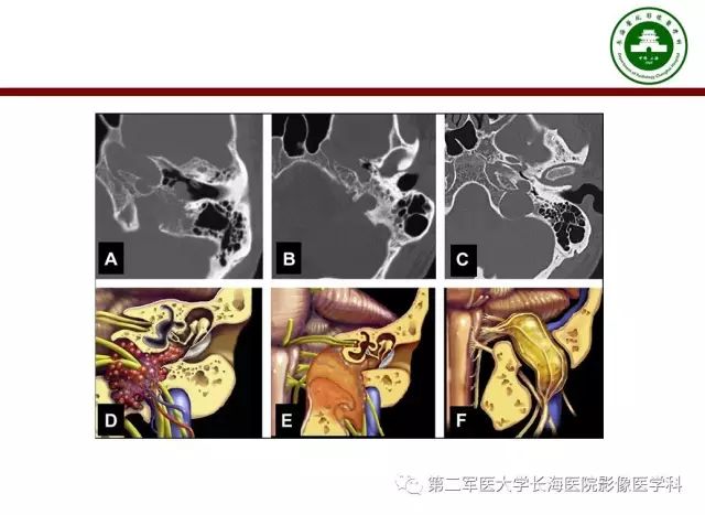 【PPT】颈静脉孔区常见病变的诊断与鉴别诊断