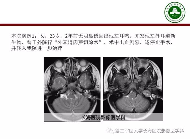 【PPT】颈静脉孔区常见病变的诊断与鉴别诊断