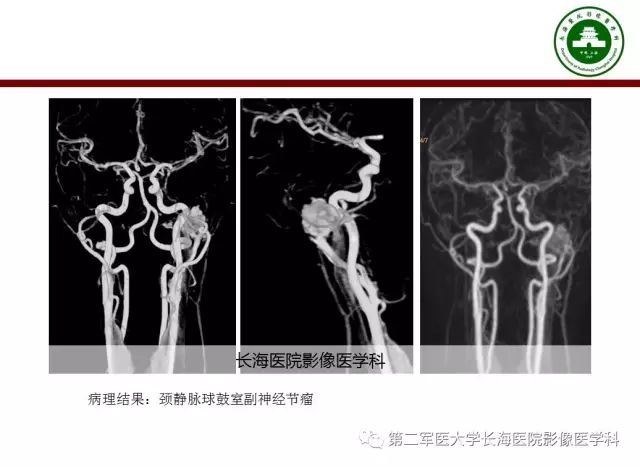 【PPT】颈静脉孔区常见病变的诊断与鉴别诊断