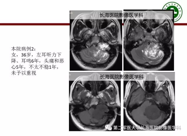 【PPT】颈静脉孔区常见病变的诊断与鉴别诊断