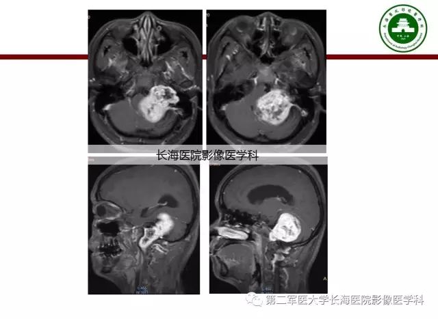 【PPT】颈静脉孔区常见病变的诊断与鉴别诊断