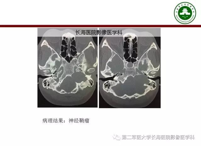 【PPT】颈静脉孔区常见病变的诊断与鉴别诊断