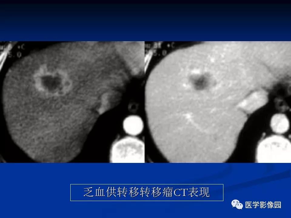 【PPT】肝脏转移瘤的影像学诊断