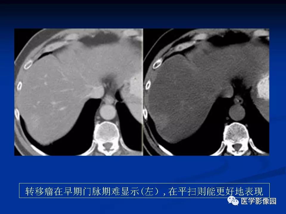 【PPT】肝脏转移瘤的影像学诊断