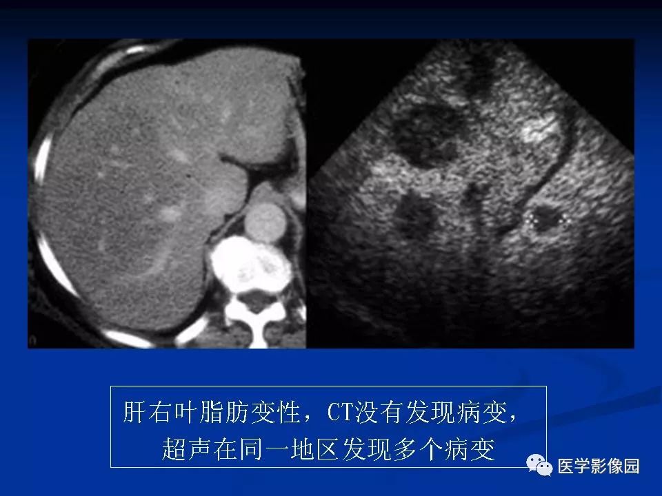 【PPT】肝脏转移瘤的影像学诊断