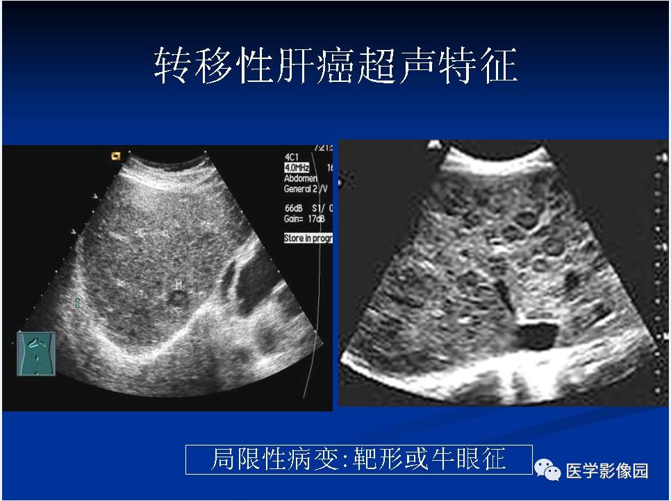 【PPT】肝脏转移瘤的影像学诊断